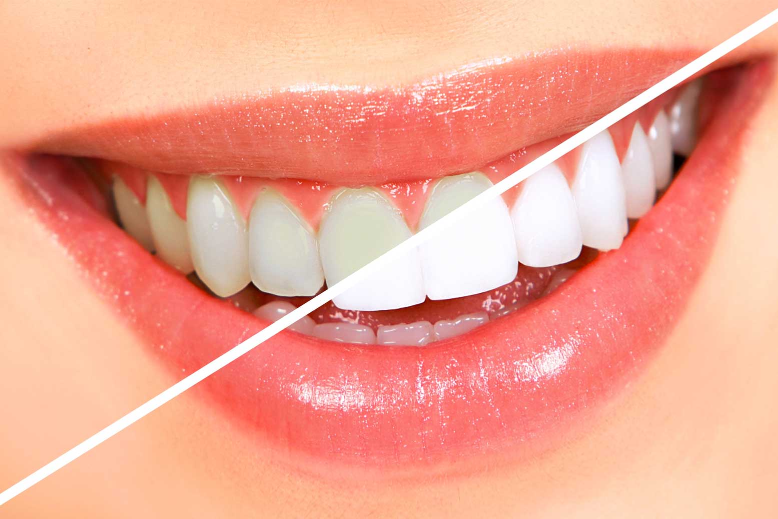 Preventive Dentistry 5bc7ea208494fc18eb9df2e6 teeth whitening