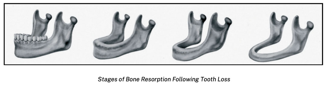 67d8fce2b93451bcef33dffd 67b42bd0c91533a5dbaab15c bone loss.webp