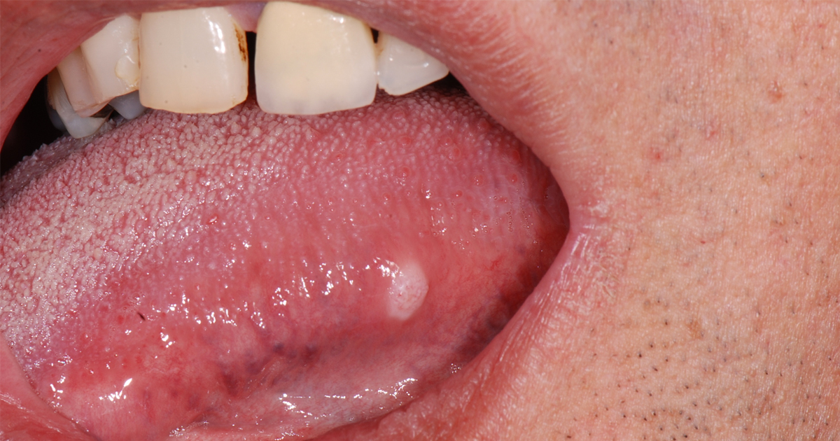 5fc07327f69d39d281519c5d article imgs 0002 oral cancer