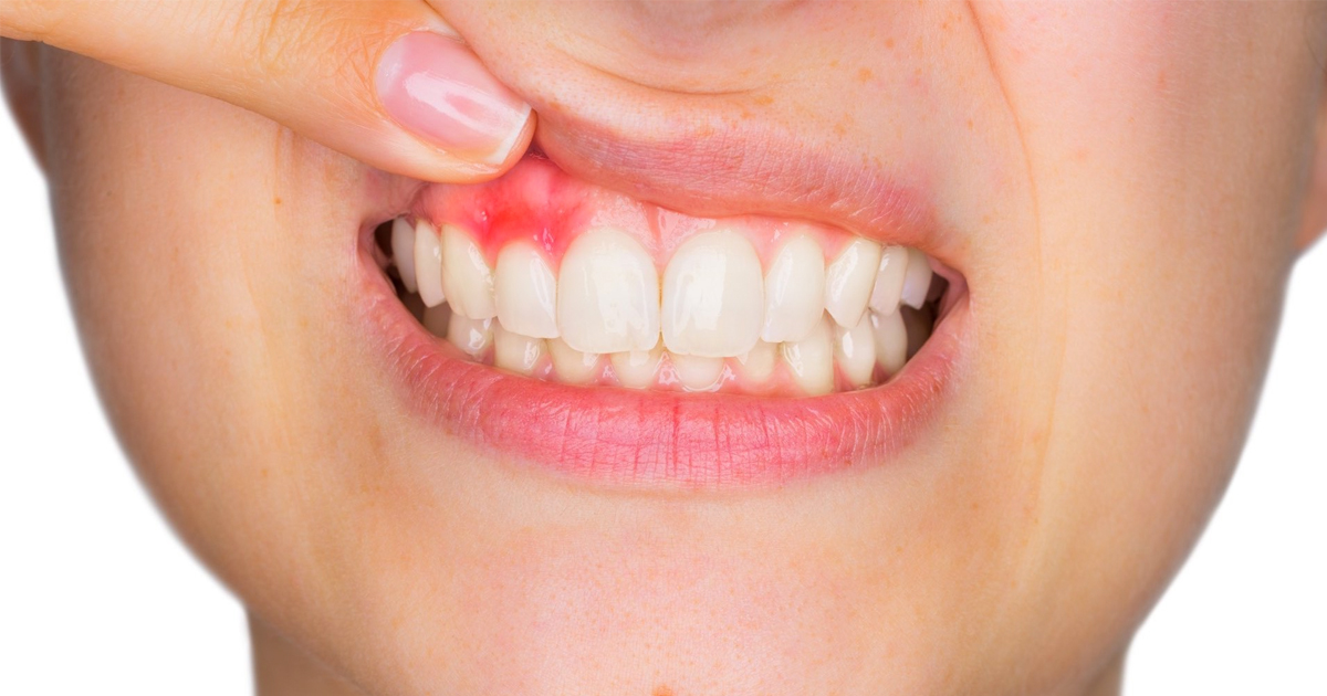 5fc0733d4a77e5105bf7d6eb article imgs 0001 gum disease