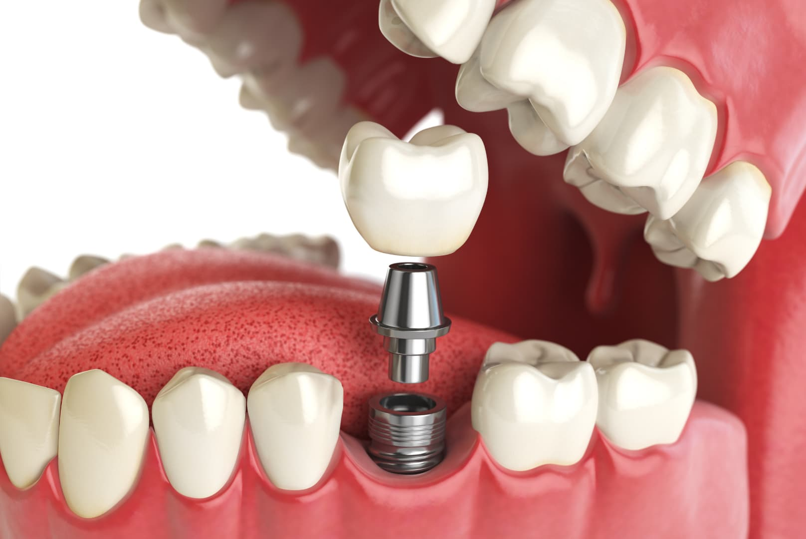 Preventive Dentistry single implant
