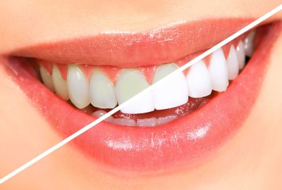 5bc7ea208494fc18eb9df2e6 teeth whitening